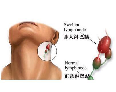 淋巴结结核